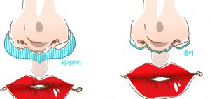 인중축소수술 디자인